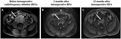 Intraoperative radiofrequency ablation for unresectable abdominal paraganglioma: a case report